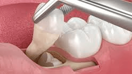 局部麻醉與手術