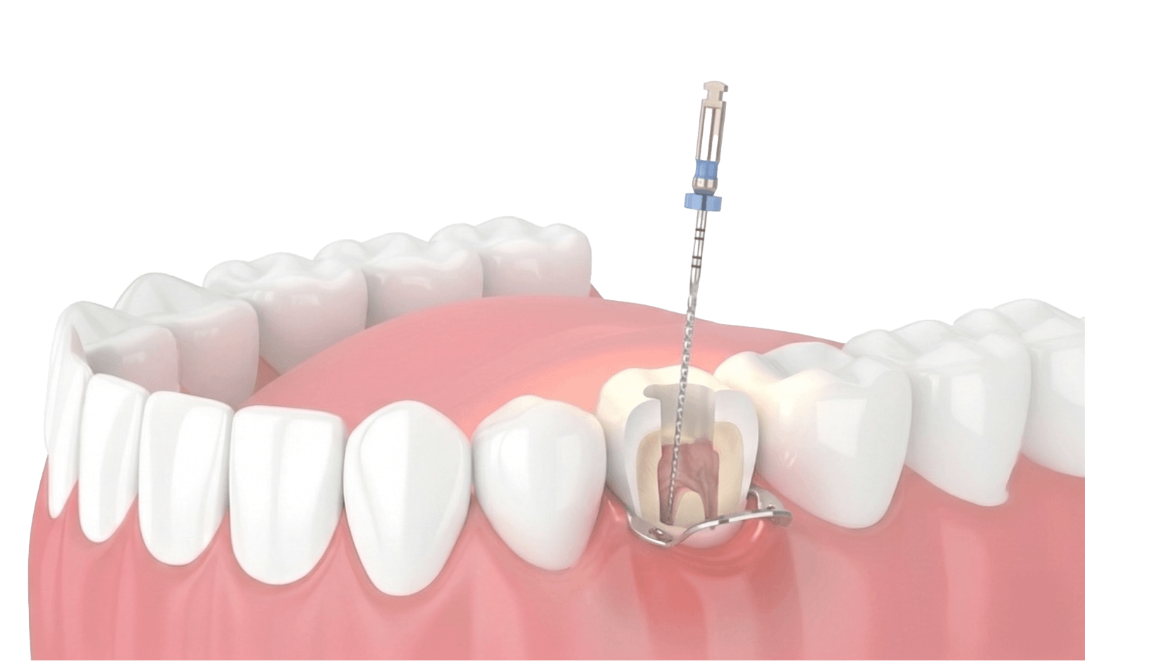 根管治療 / 杜牙根