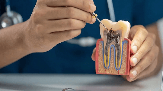 清除受感染牙髓