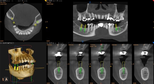 3D 立體電腦掃描