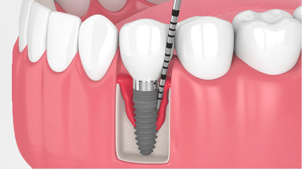 牙周袋深度探測