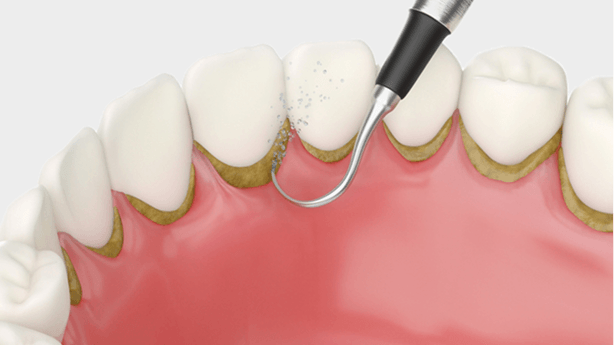 深層洗牙 (牙根刮治)