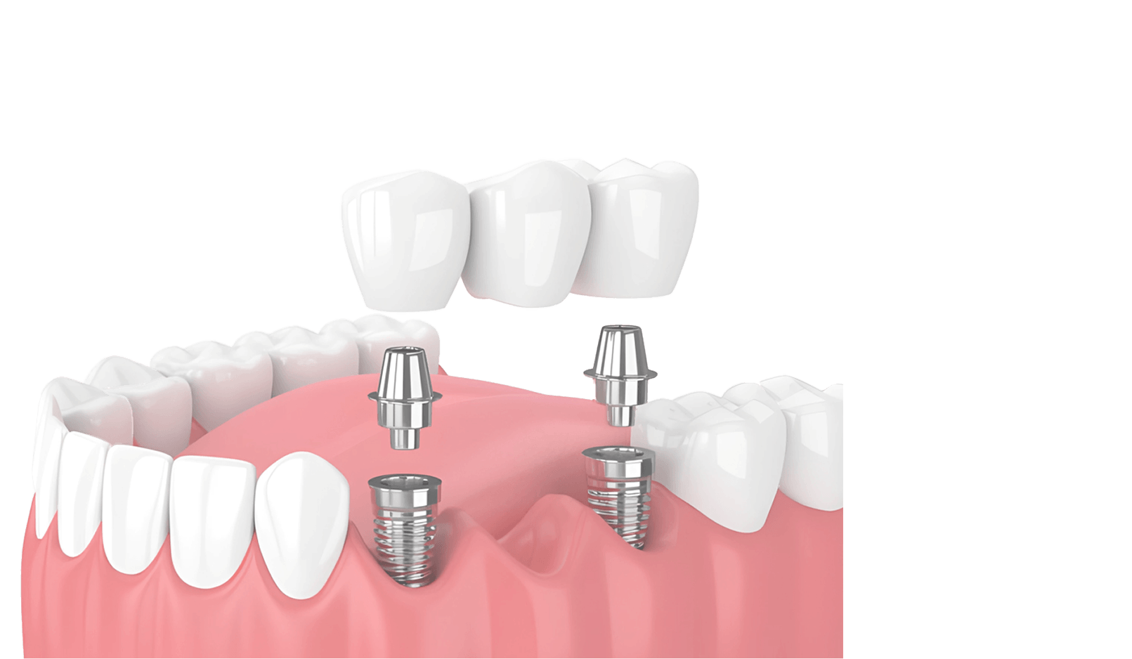 人工植牙 / 種牙