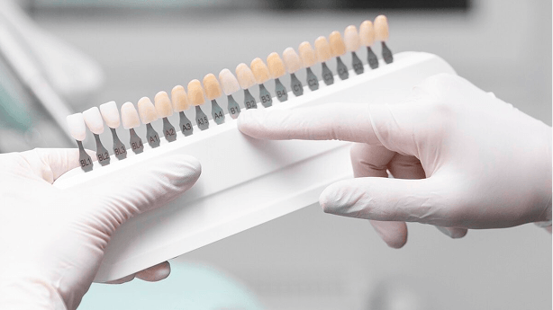 全瓷美白貼片 (Veneers)