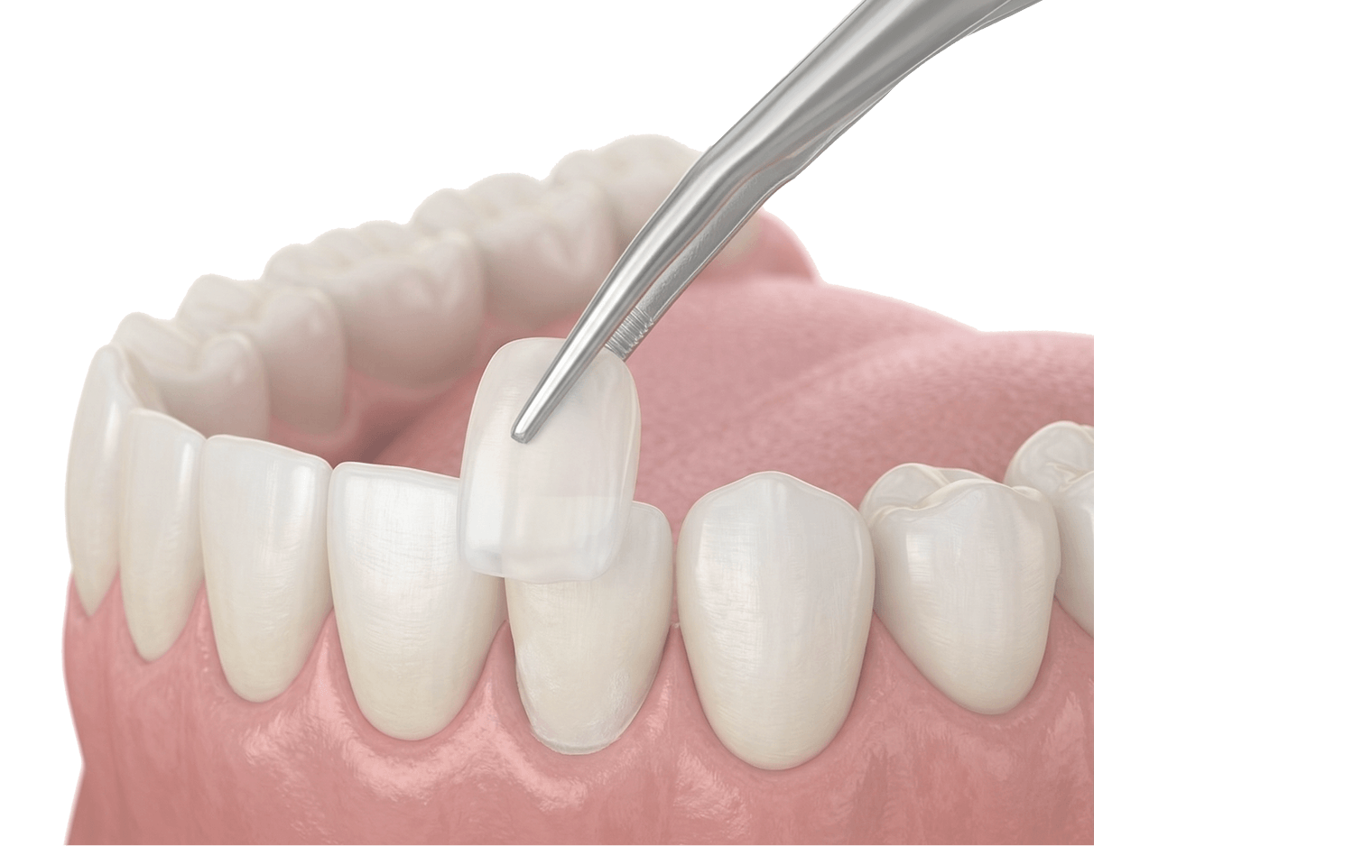 牙齒美容 (美白/瓷片)