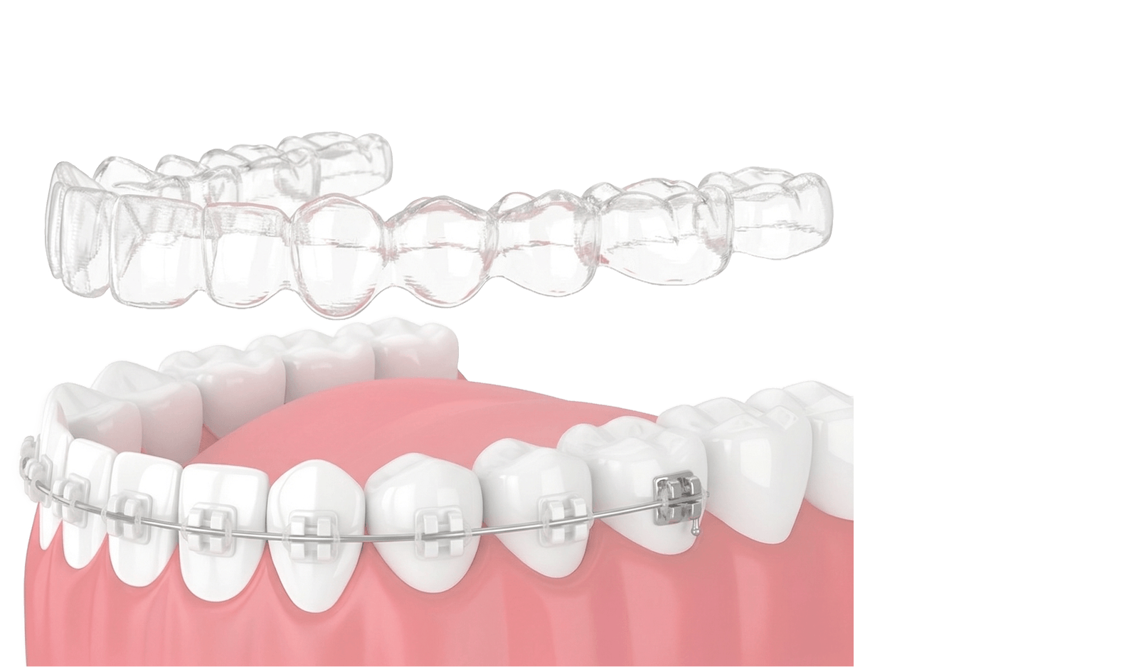 牙齒矯正 / 箍牙