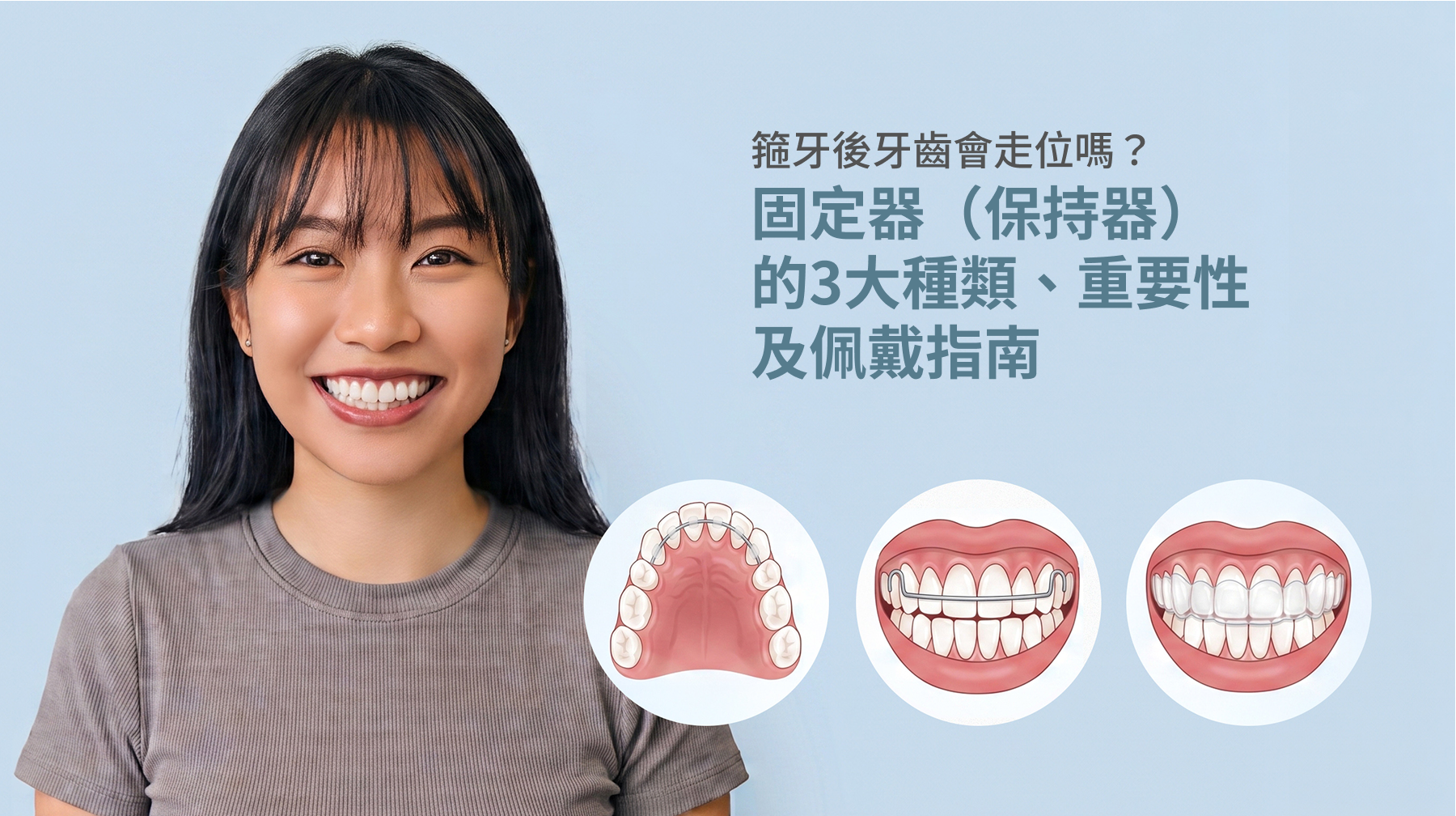 箍牙後牙齒會走位嗎？固定器（保持器）的3大種類、重要性及佩戴指南